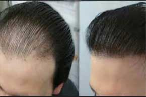 Hair Transplant Clinic in Delhi | Hair Weaving & Bonding in Delhi- Looks  Enhance