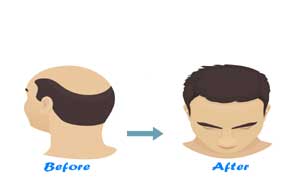 Hair Treatment clinic, Hair bonding, Hair weaving in Delhi, Noida, Lucknow,  Varanasi, Ranchi- Looks Enhance-Hair & Skin Clinic