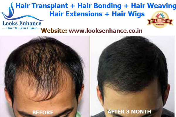 Hair Treatment Clinic in Noida | Hair Bonding, Hair Replacement Center in  Noida